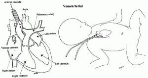 ecmo